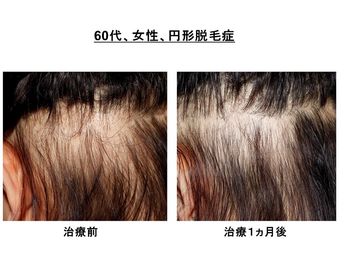 円形脱毛症　病院